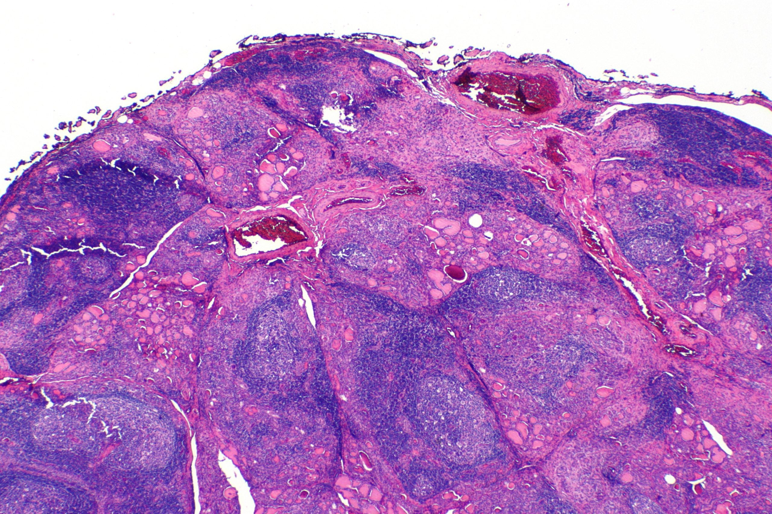 Clean Air Helps to Heal Hashimoto’s Disease